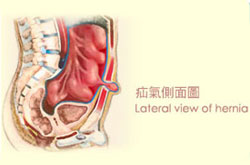 Hernia Hernia